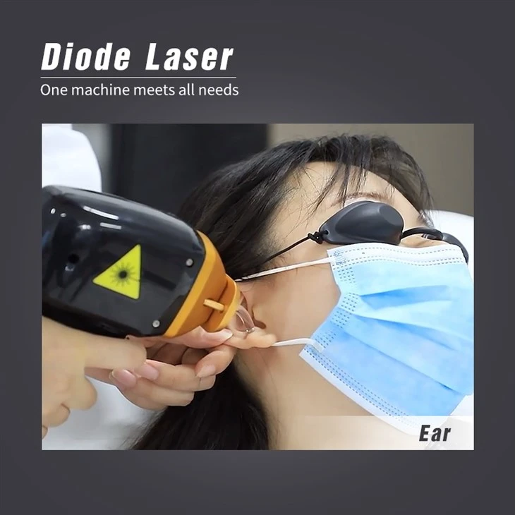 The Best Diode Laser Hair Removal