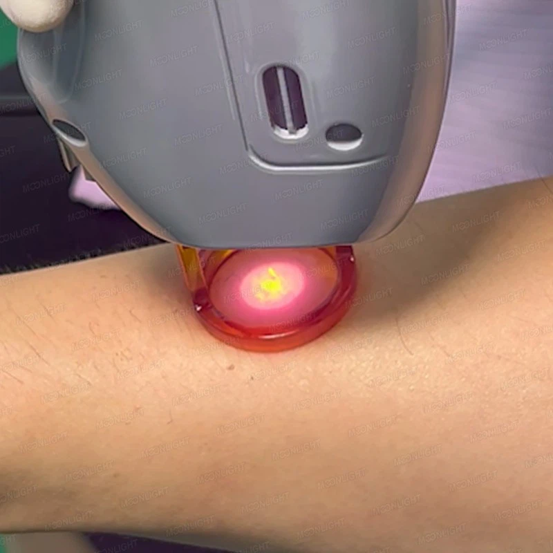 Candela Hair Removal Machine high quality
