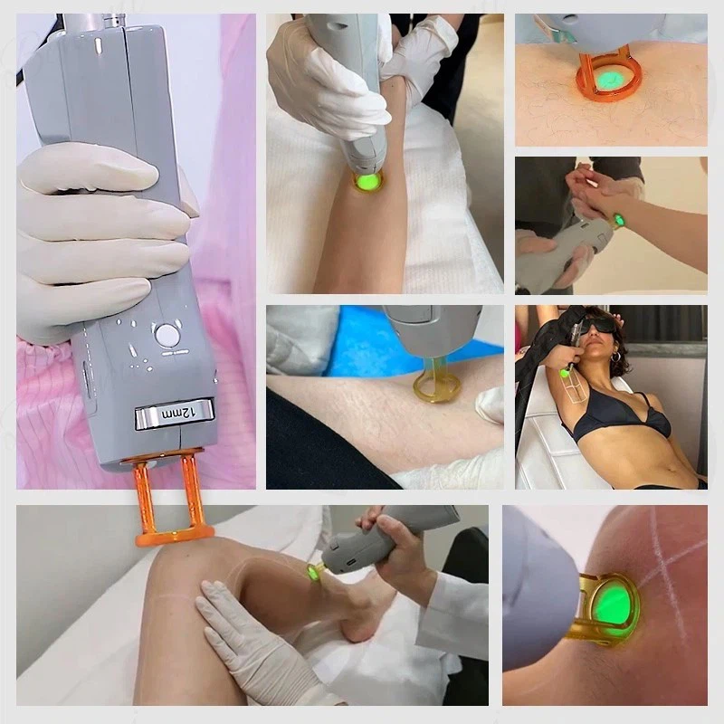 Candela Hair Removal suppliers