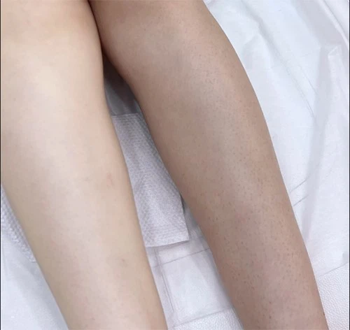 Hair-removal-and-whitening